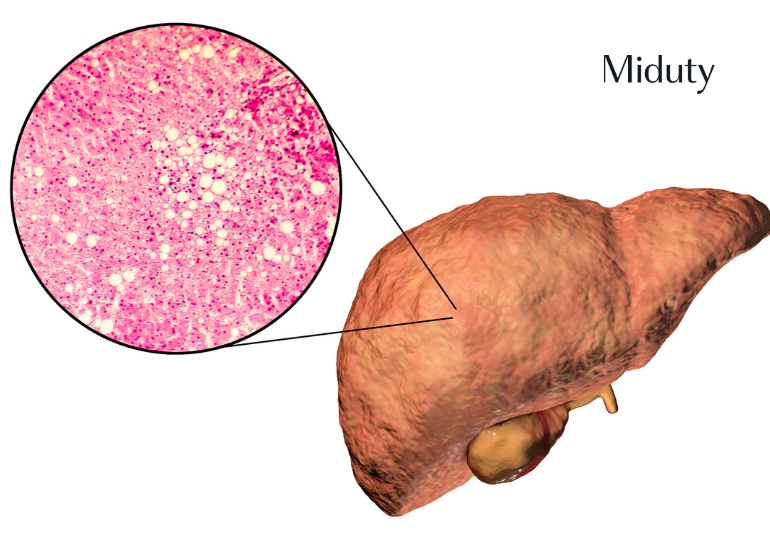 How High Fructose or Sugar Can Lead To Fatty Liver Disease