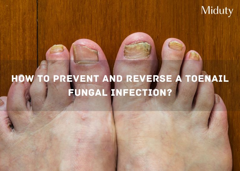 Toenail Fungal Infection: Causes, Symptoms, Treatments