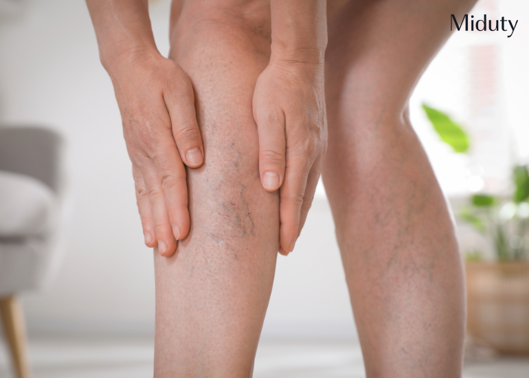 glutathione varicose veins Exercises for Varicose Veins: How to Manage and Improve Circulation glutathione varicose veins Exercises for Varicose Veins: How to Manage and Improve Circulation