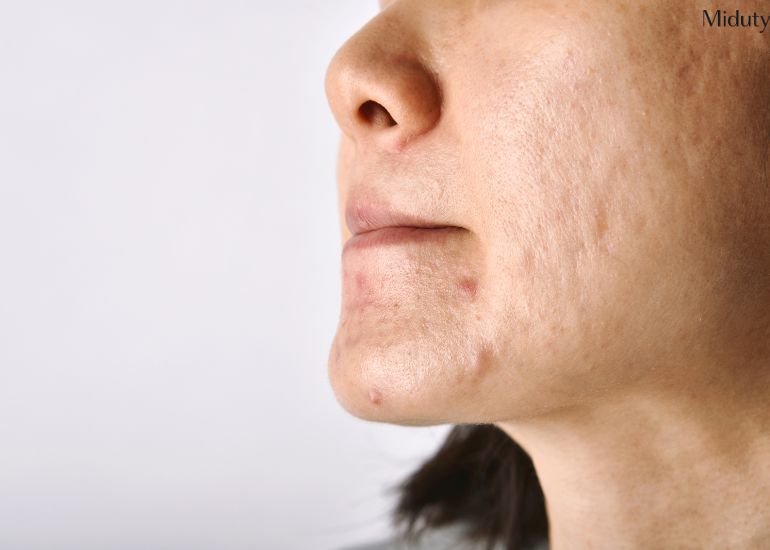 Understanding Perioral Pigmentation: Causes, Symptoms, and Effective Treatments