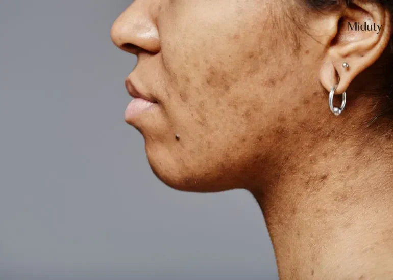 Hormonal Imbalance and Skin Pigmentation: How To Manage? - Miduty Hormonal Imbalance and Skin Pigmentation: How To Manage? - Miduty