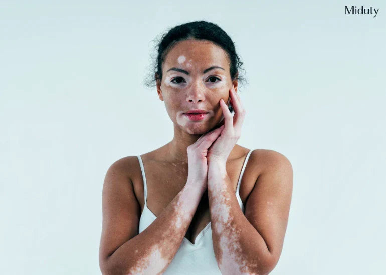 Hypopigmentation: Causes, Types, Diet, Skin Care & Supplements